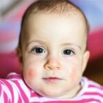 Bebeklerde Alerji Belirtileri, Nedenleri ve Çözüm Önerileri 41 Bebek Alerji 1 min